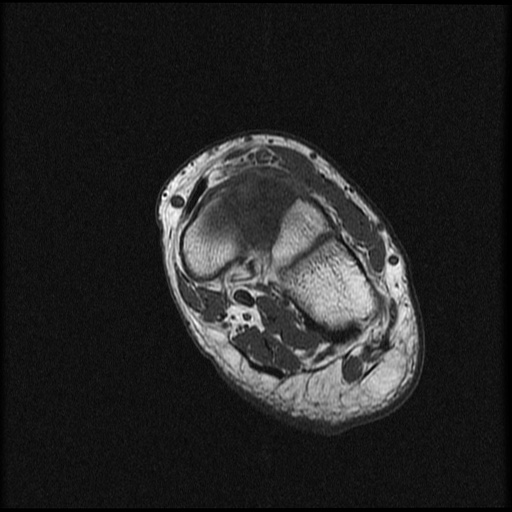 File:Chondroblastoma - midfoot (Radiopaedia 64831-73765 Short axis T1 12).jpg