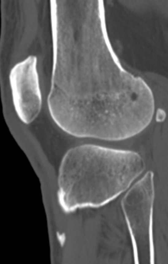 Chondrocalcinosis (Radiopaedia 82862-97173 Sagittal bone window 49).jpg
