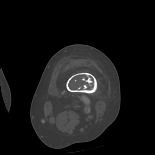 Chondrosarcoma - femur (Radiopaedia 64187-72954 Axial bone window 19).jpg