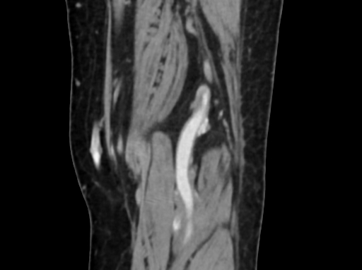 Chondrosarcoma - femur (Radiopaedia 64187-72954 C 52).jpg