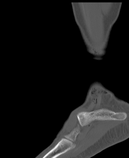 Chopart fracture (Radiopaedia 35347-36851 Sagittal bone window 54).jpg