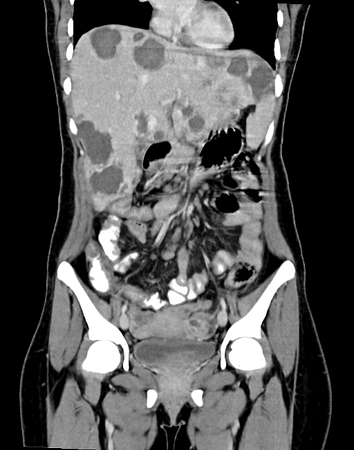 Choriocarcinoma liver metastases (Radiopaedia 74768-85766 B 46).jpg