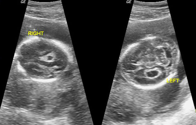 File:Choroid plexus cyst (Radiopaedia 30795-31499 B 1).jpg