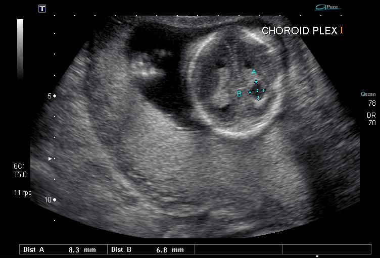 File:Choroid plexus cyst (Radiopaedia 7704-8523 Transverse 1).jpg