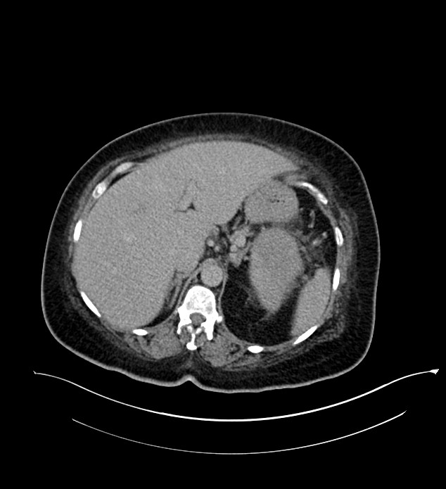 Chromophobe renal cell carcinoma (Radiopaedia 84239-99519 E 51).jpg