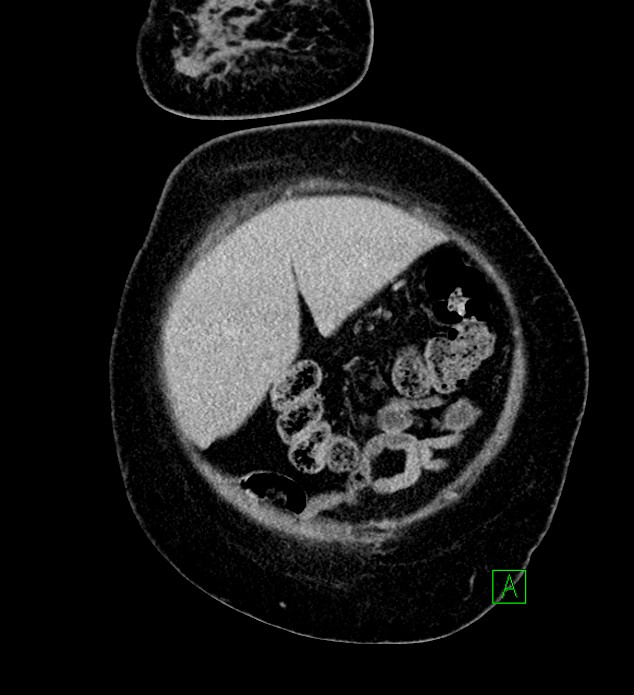 Chromophobe renal cell carcinoma (Radiopaedia 84239-99519 F 14).jpg