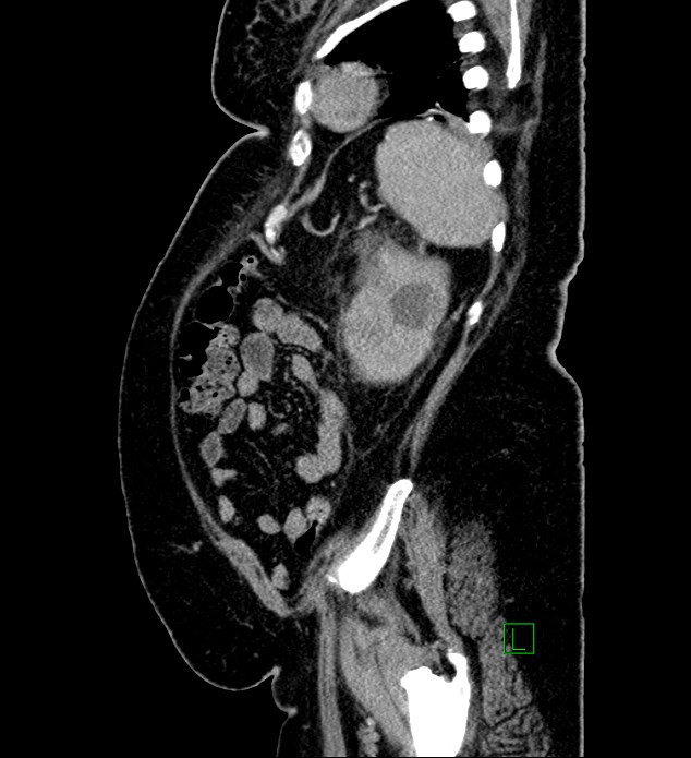 Chromophobe renal cell carcinoma (Radiopaedia 84239-99519 G 26).jpg