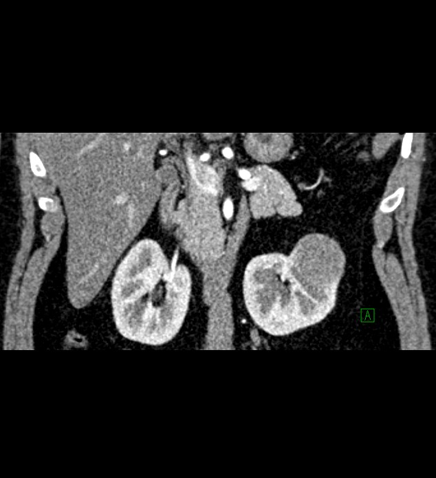 Chromophobe renal cell carcinoma (Radiopaedia 84286-99573 E 29).jpg