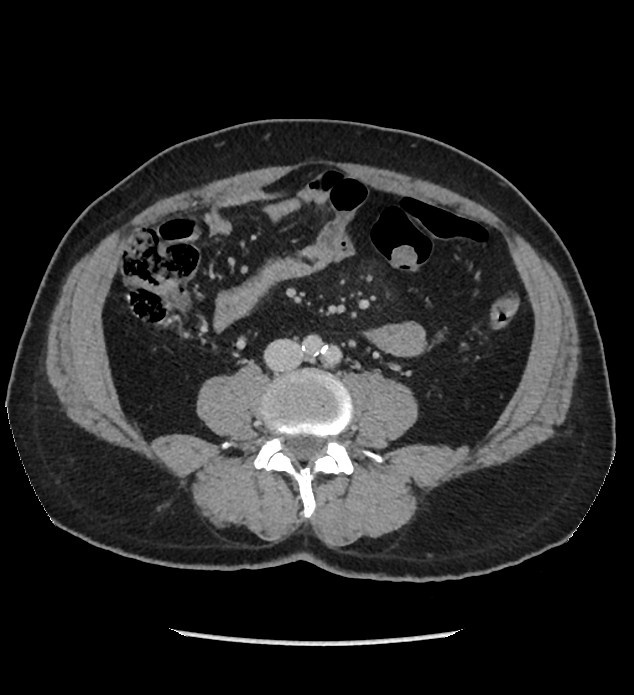Chromophobe renal cell carcinoma (Radiopaedia 86879-103083 C 86).jpg