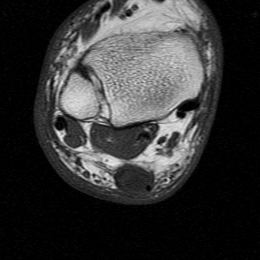 File:Chronic Achilles tendon rupture (Radiopaedia 15262-15100 Axial T1 10).jpg