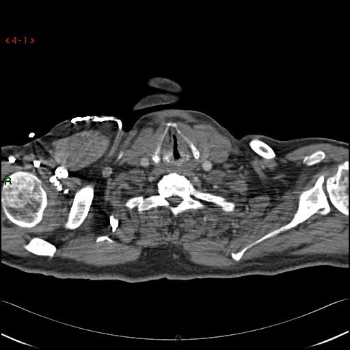 File:Chronic aortic dissection type B and repaired aortic dissection type A (Radiopaedia 15634).jpg
