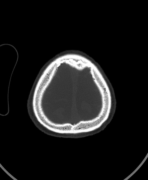 Chronic bilateral subdural hygroma (Radiopaedia 85801-101623 Axial bone window 21).jpg