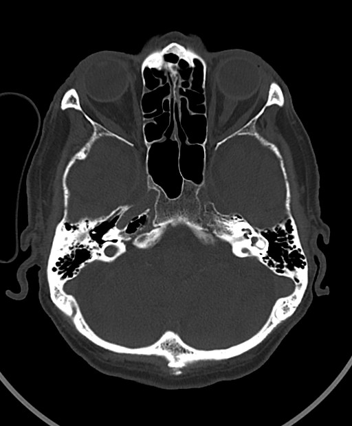 Chronic bilateral subdural hygroma (Radiopaedia 85801-101623 Axial bone window 93).jpg