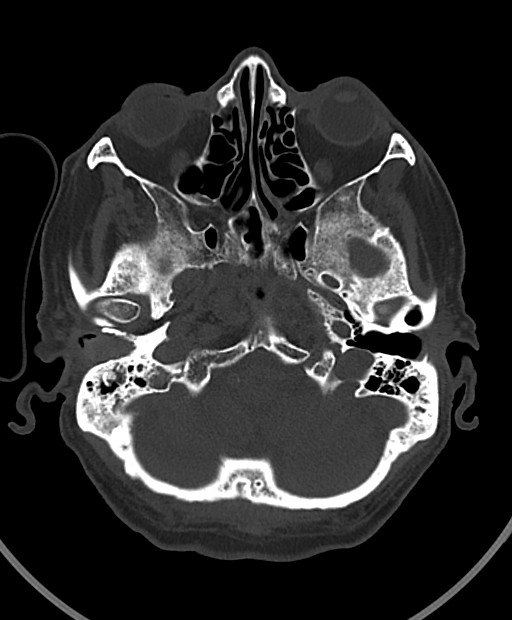 Chronic bilateral subdural hygroma (Radiopaedia 85801-101623 Axial bone window 99).jpg