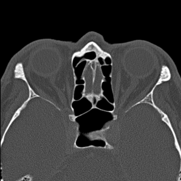 Chronic maxillary sinusitis (Radiopaedia 27879-28116 Axial bone window 37).jpg