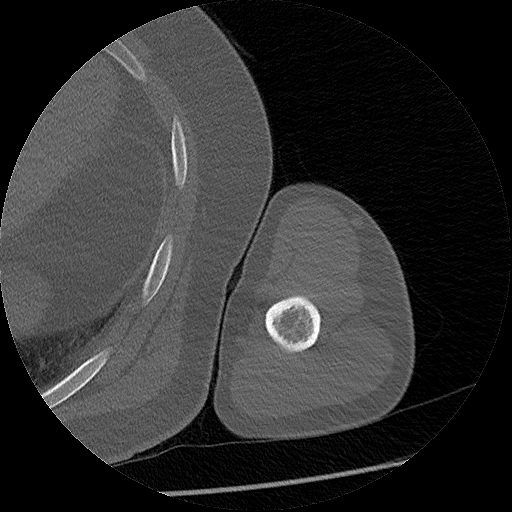 Chronic osteomyelitis (Radiopaedia 67597-76998 Axial bone window 34).jpg