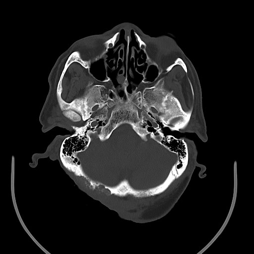 Chronic osteomyelitis - calvarial (severe) (Radiopaedia 69668-79616 Axial bone window 30).jpg