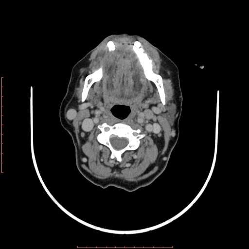 File:Chronic osteomyelitis - maxilla (Radiopaedia 23783-23927 B 21).jpg