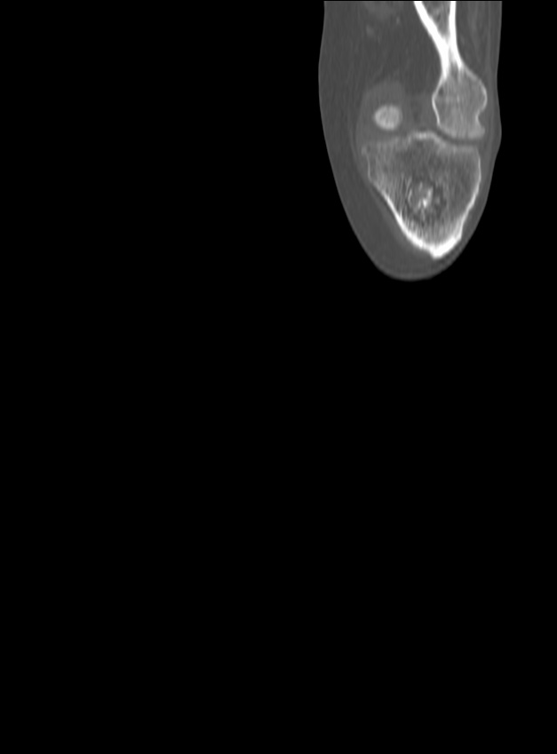 Chronic osteomyelitis - tibia (with sequestrum) (Radiopaedia 73273-84090 Coronal non-contrast 15).jpg