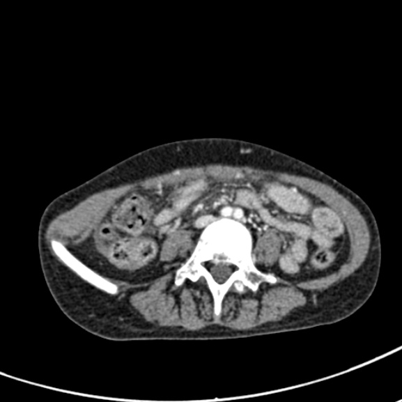 Chronic pancreatitis (Radiopaedia 55405-61846 A 64).jpg