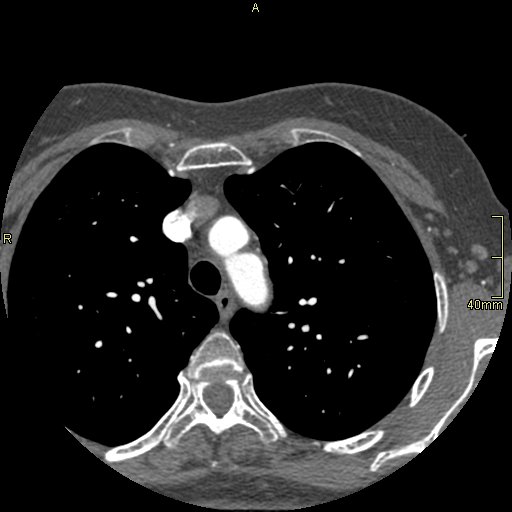 Chronic pulmonary embolism (Radiopaedia 73073-85094 Axial C+ CTPA 14).jpg