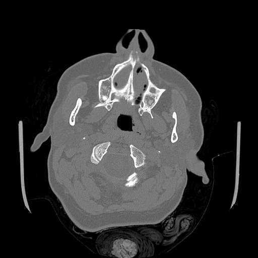File:Chronic sinusitis with intra-sinus calcification (Radiopaedia 63919-72668 Axial bone window 77).jpg
