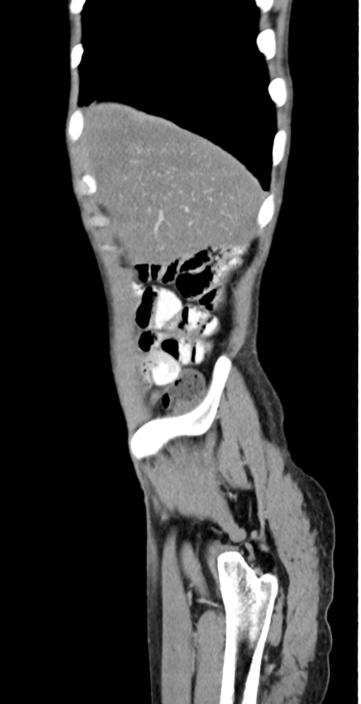 Chronic small bowel volvulus (Radiopaedia 75224-86322 C 126).jpg