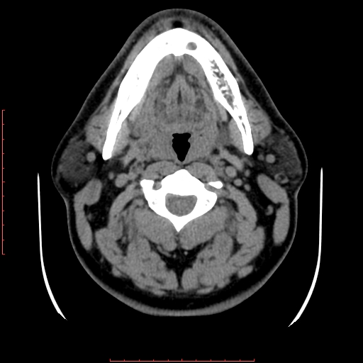 Chronic submandibular sialolithiasis (Radiopaedia 69817-79814 Axial non-contrast 95).jpg