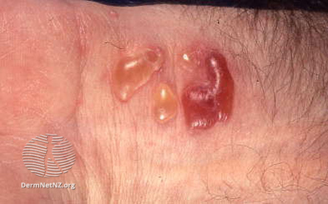 File:Cicatricial pemphigoid (DermNet NZ immune-cic-pem3).jpg