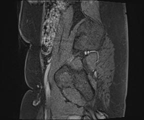 File:Class II Mullerian duct anomaly- unicornuate uterus with rudimentary horn and non-communicating cavity (Radiopaedia 39441-41755 G 116).jpg