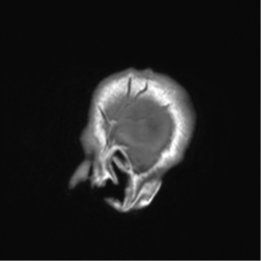 Clival chordoma invading the hypoglossal canal (Radiopaedia 48850-53887 Sagittal T1 10).png
