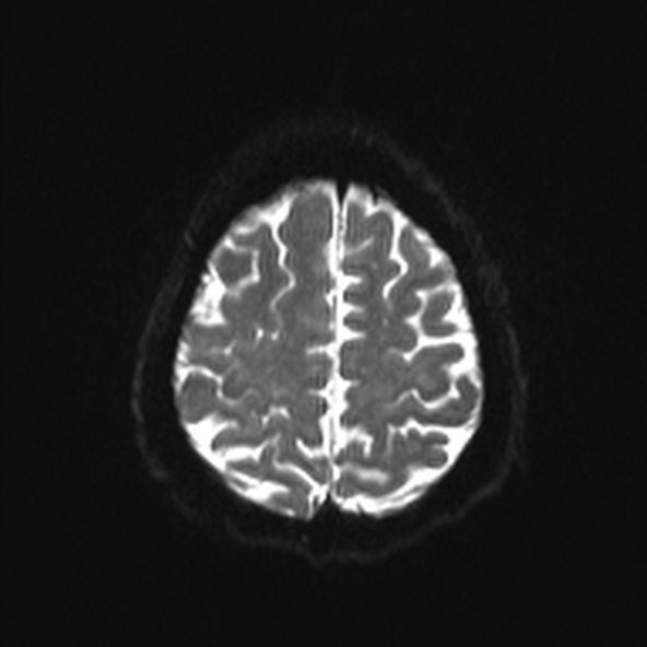 File:Clival meningioma (Radiopaedia 53278-59248 Axial DWI 21).jpg