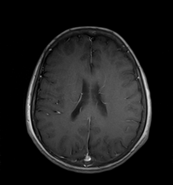 File:Clival meningioma (Radiopaedia 53278-59248 Axial T1 C+ 15).jpg