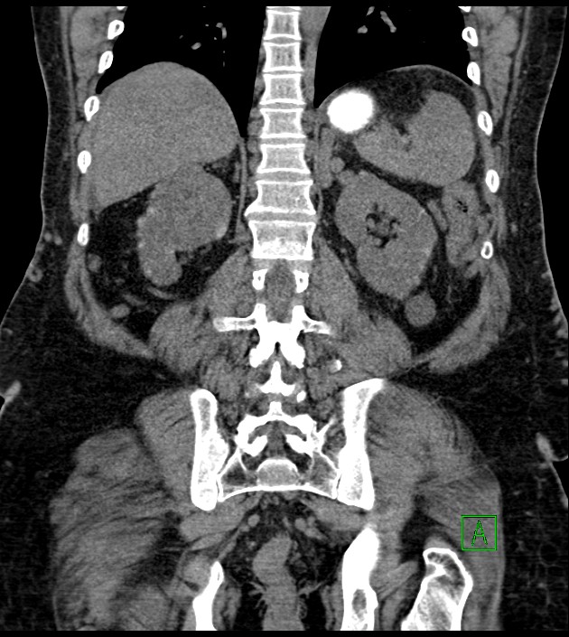 Closed-loop small bowel obstruction-internal hernia (Radiopaedia 78439-91096 Coronal non-contrast 74).jpg