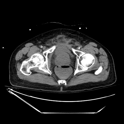 Closed loop obstruction due to adhesive band, resulting in small bowel ischemia and resection (Radiopaedia 83835-99023 Axial non-contrast 148).jpg