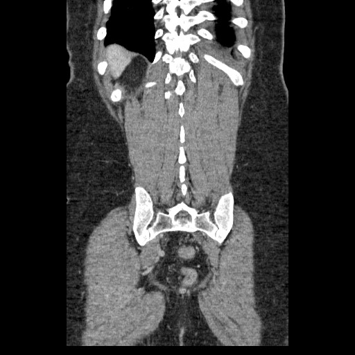 Closed loop small bowel obstruction (Radiopaedia 65403-74451 B 88).jpg
