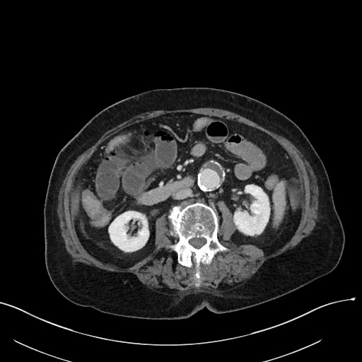 File:Closed loop small bowel obstruction - adhesions (Radiopaedia 59269-66611 Axial 29).jpg