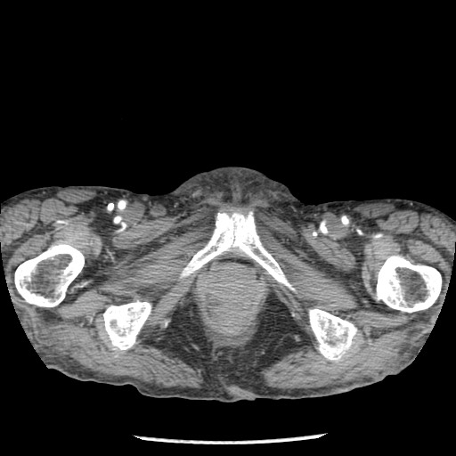 Closed loop small bowel obstruction - adhesions and infarct (Radiopaedia 85125-100678 A 220).jpg