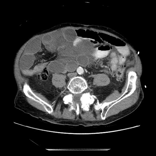 Closed loop small bowel obstruction - adhesive disease and hemorrhagic ischemia (Radiopaedia 86831-102990 A 123).jpg