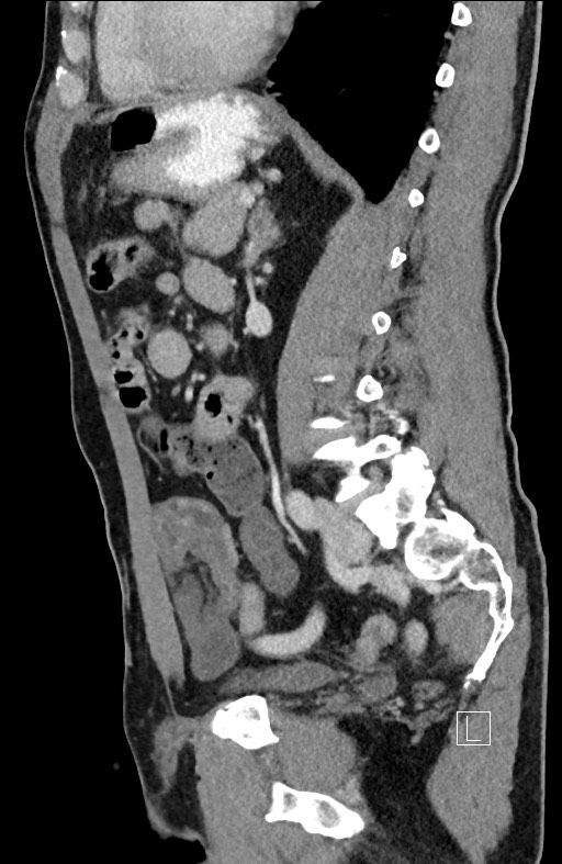 Closed loop small bowel obstruction - internal hernia (Radiopaedia 57806-64778 C 46).jpg