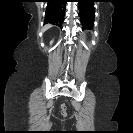 Closed loop small bowel obstruction - internal hernia (Radiopaedia 65402-74450 B 89).jpg