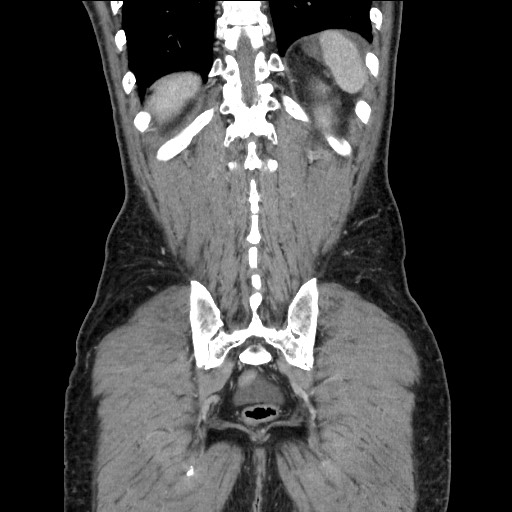 Closed loop small bowel obstruction - omental adhesion causing "internal hernia" (Radiopaedia 85129-100682 B 107).jpg
