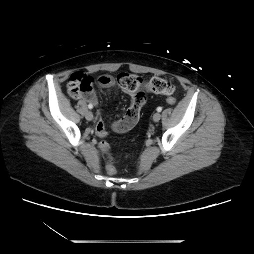 File:Closed loop small bowel obstruction due to adhesive bands - early and late images (Radiopaedia 83830-99014 A 124).jpg