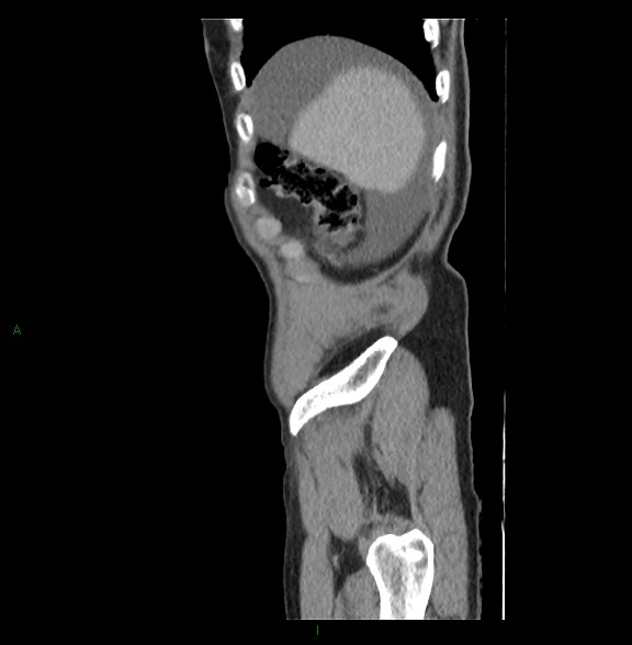 Closed loop small bowel obstruction with ischemia (Radiopaedia 84180-99456 C 11).jpg