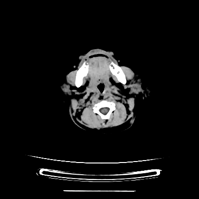 File:Cloverleaf skull (Radiopaedia 91901-109710 Axial non-contrast 29).jpg