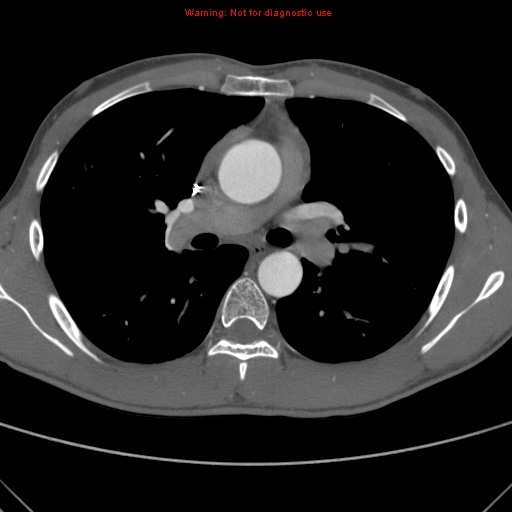 File:Coarctation of the aorta (Radiopaedia 9434-10118 A 83).jpg