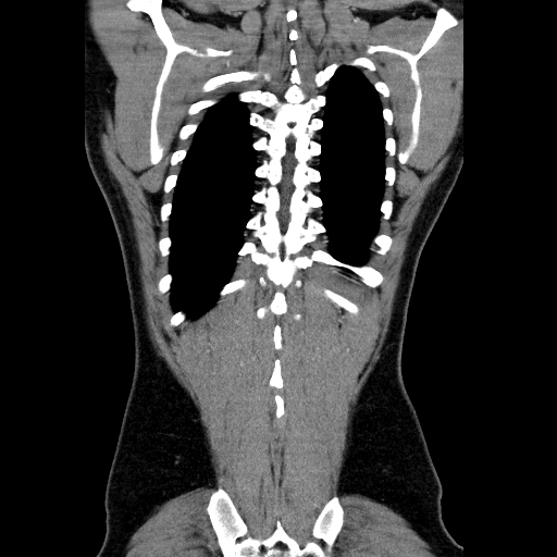 File:Codominant double aortic arch (Radiopaedia 56012-62637 B 42).jpg