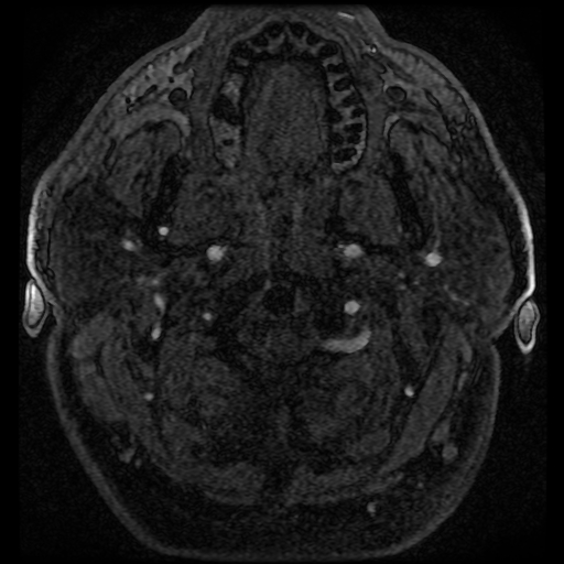File:Colloid cyst with anterior communicating artery aneurysm (Radiopaedia 33901-35091 Axial MRA 13).jpg
