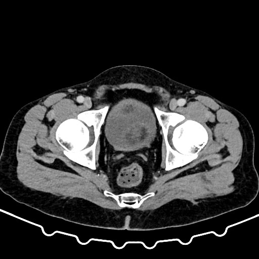 File:Colocolic intussusception due to large lipoma (Radiopaedia 68773-78482 A 181).jpg
