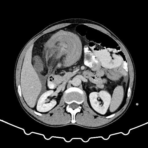 Colocolic intussusception due to large lipoma (Radiopaedia 68773-78482 A 64).jpg